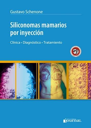 SILICONOMAS MAMARIOS POR INYECCIÓN. CLÍNICA, DIAGNÓSTICO, TRATAMIENTO 01/2017