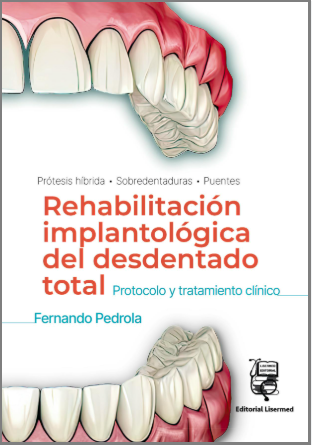REHABILITACION IMPLANTOLOGICA DEL DESDENTADO TOTAL. PROTOCOLO Y TRATAMIENTO CLINICO 01 / 2024
